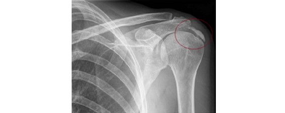tendinitis calcificante de hombro