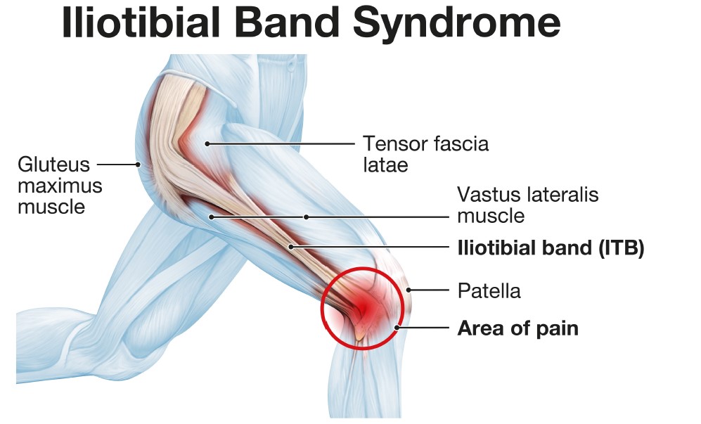 Síndrome de la Cintilla Iliotibial