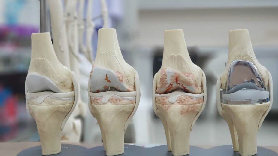 protesis de rodilla personalizada Revenga