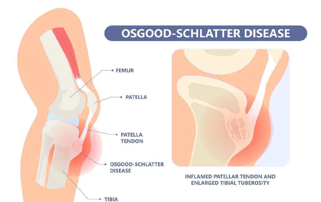 ENFERMEDAD DE OSGOOD-SCHLATTER