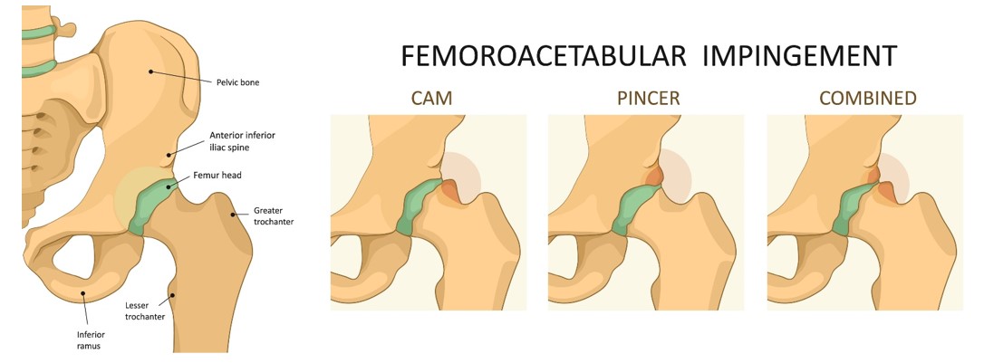 CHOQUE FEMORO-ACETABULAR 1